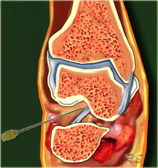 超声引导穿刺和介入穿刺的优缺点,关节超声引导