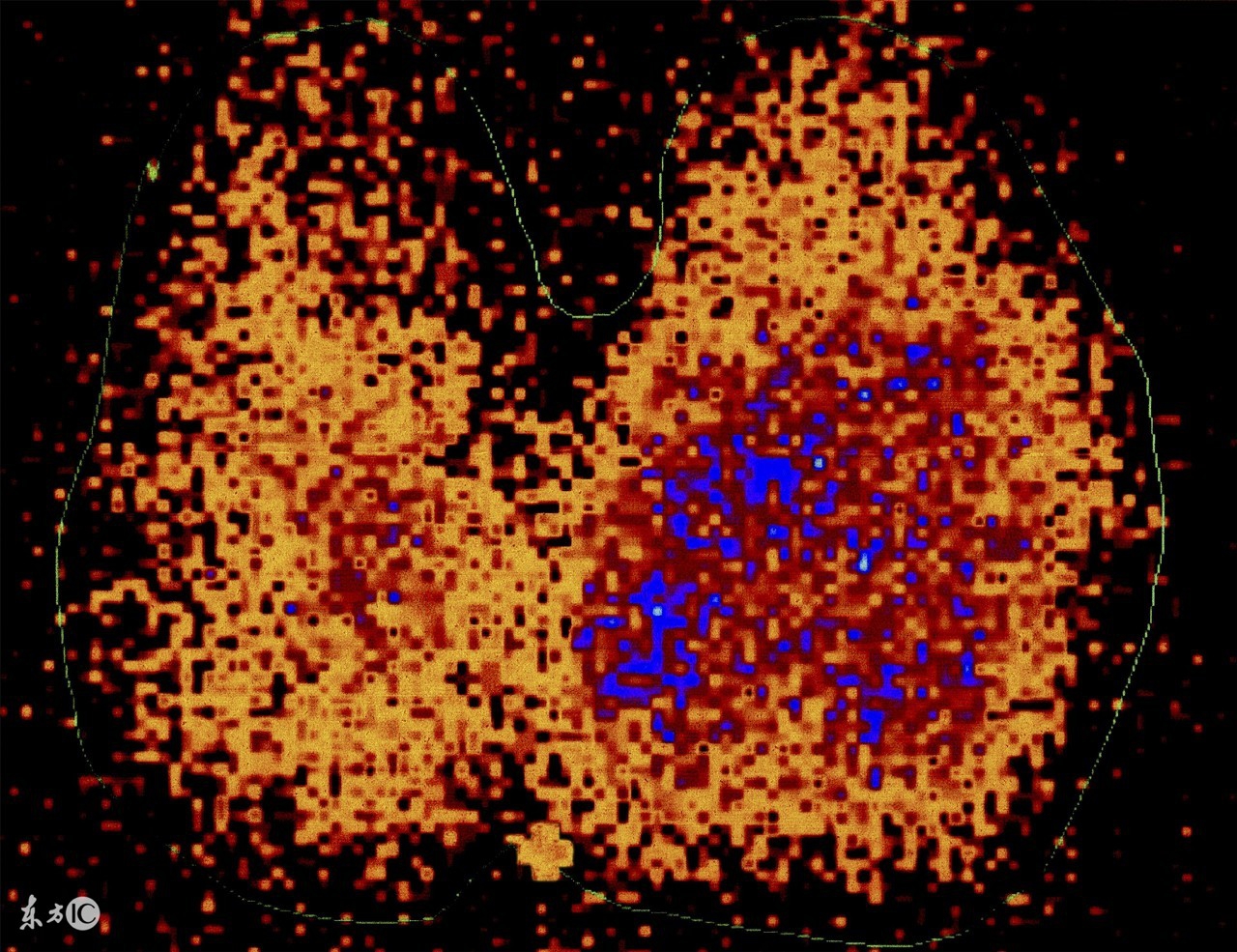 甲状腺同位素I131,131i甲状腺功能测定不能吃什么