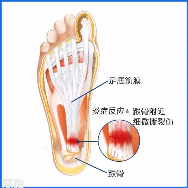 全球治好足跟痛,足底疗法治百病
