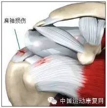 肩峰撞击综合征肩袖损伤怎么治疗,肩峰下撞击综合征导致肩袖损伤