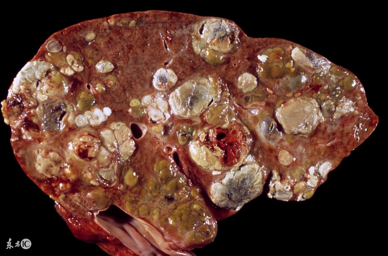 乙肝患者发生肝硬化，不要害怕，关键是要做到以下一点