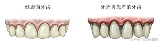 第一次洗牙后牙缝太大了怎么办,为什么洗牙后牙缝越来越大