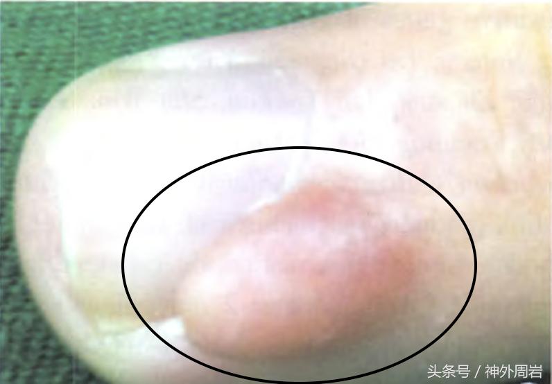 神经断裂后的再生痛苦,创伤性神经瘤症状和治疗