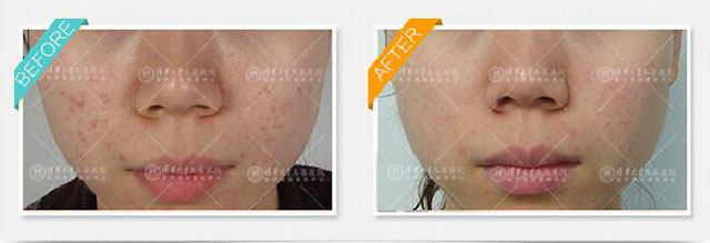 青春痘有什么方法解决,青春期已经长痘了怎么改善皮肤