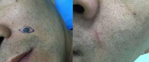 痣上长小疙瘩是什么原因,痣小比较深怎么办