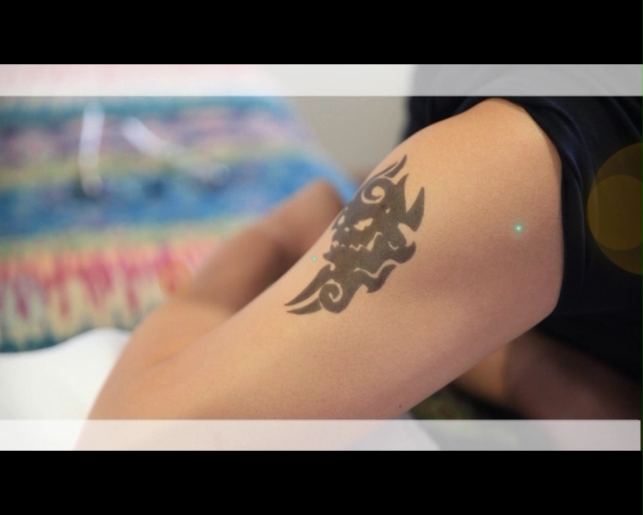 去除纹身激光得花多少钱,激光去除纹身的原理