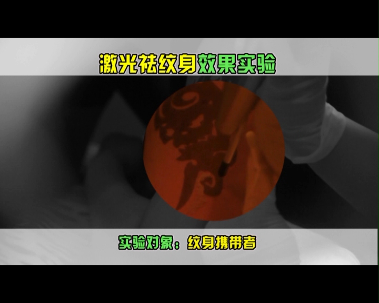 去除纹身激光得花多少钱,激光去除纹身的原理