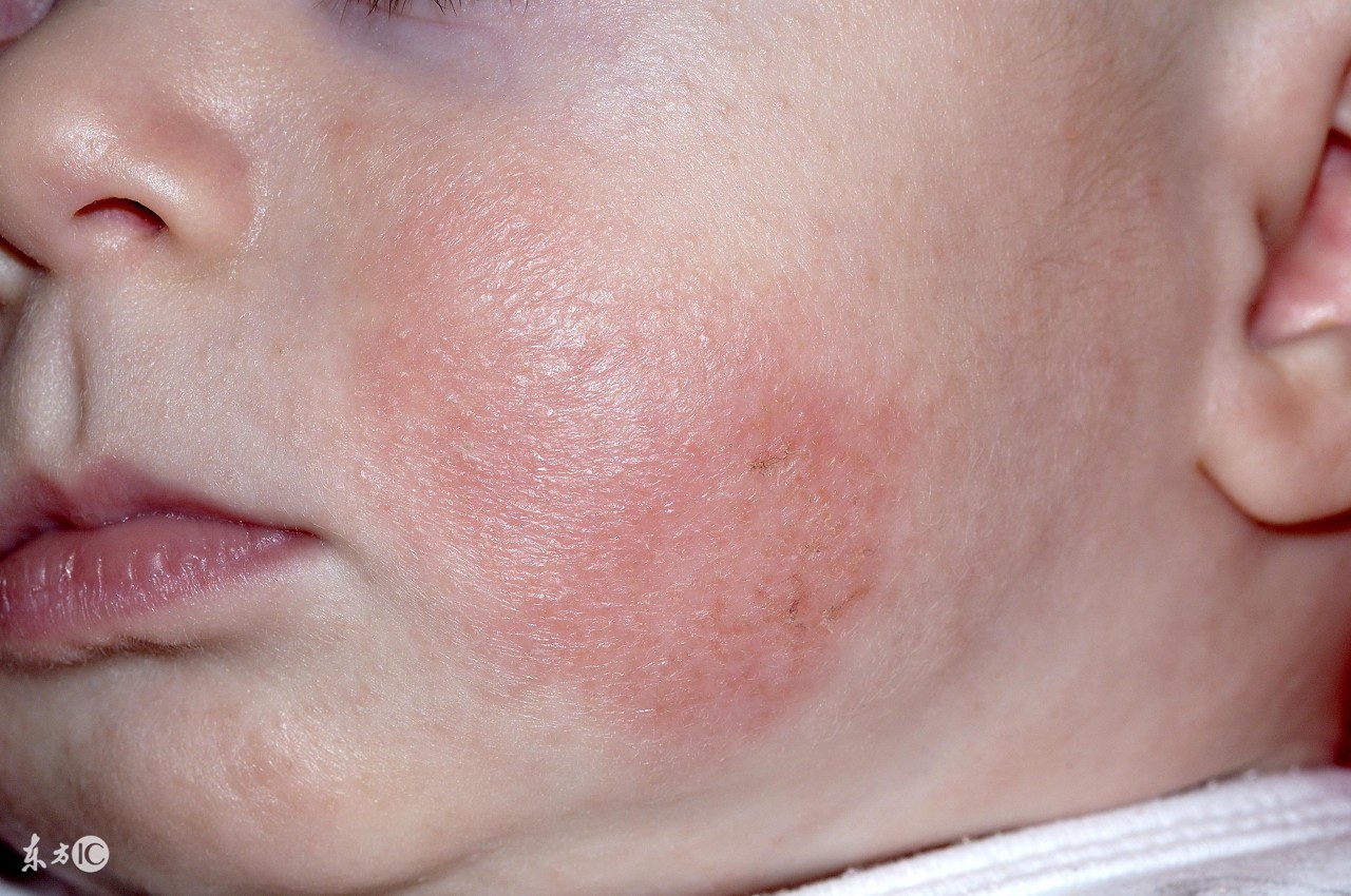 婴幼儿湿疹推荐保湿面霜,宝宝湿疹用哪款面霜好