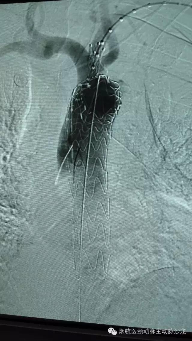 胃动脉溃疡,胃溃疡的溃疡点在主动脉