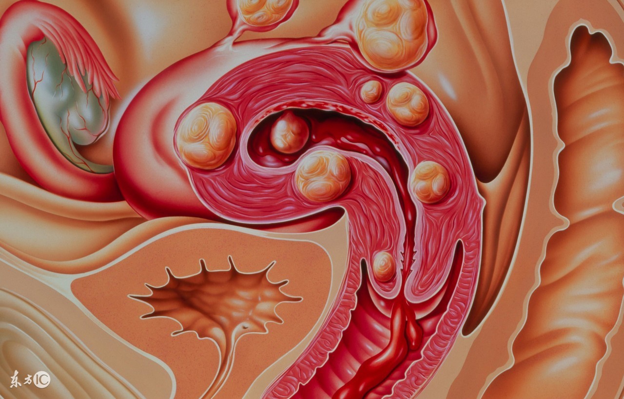 鉴别子宫肌瘤,检查子宫肌瘤做b超还是阴超