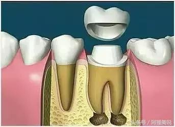 根管治疗最后补牙单独收费的吗,根管治疗最后一步需要多少钱
