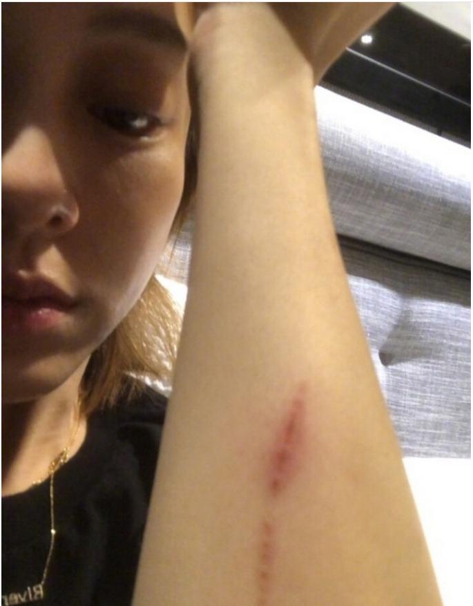 范玮琪受伤的原因,范玮琪受伤事件