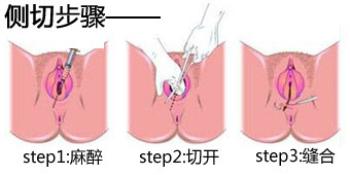 顺产侧切影响过来人的亲身感受,顺产侧切真实经历