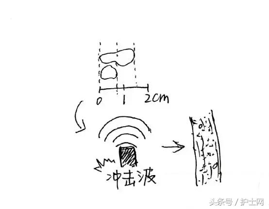 经常跳跳就可以将肾结石蹦出来吗,经常跳跳有助于长高吗