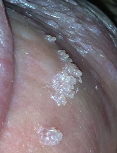 尖锐性湿疣治疗需要注意什么,尖锐性湿疣的治疗期间注意事项