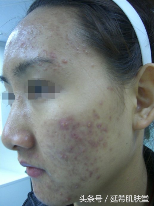 换季就长痘什么原因,一到换季就长痘怎么回事