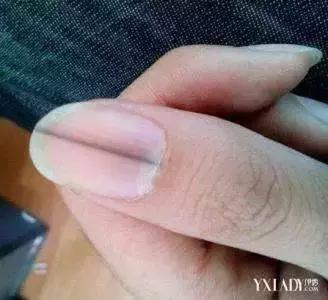 指甲出现哪些症状是有问题的,指甲上有皱纹有什么信号求救