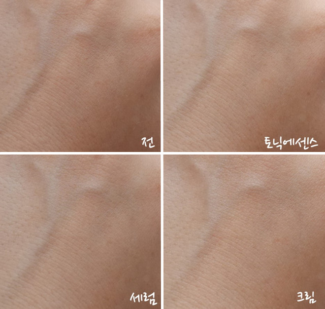 轻松修复痘印告别痘痘肌,有效快速祛痘印