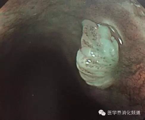 食管良性肿瘤科普视频,食管乳头状瘤和增生区别