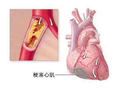 心内科检查是否心肌梗死都查什么,因心肌梗死去世的年轻人