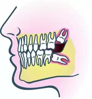 智齿有点轻微发炎怎么办,智齿发炎肿痛张不开嘴治疗过程
