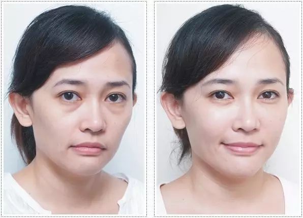 眼袋显老还是泪沟显老,40岁眼袋有泪沟怎么办