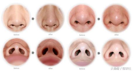 女生怎么逆袭蒜头鼻,女生通天鼻怎么修