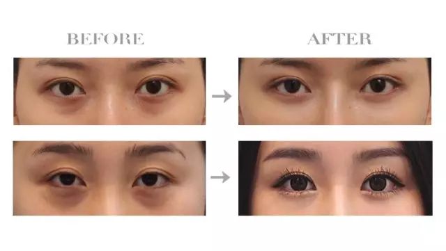 眼袋显老还是泪沟显老,40岁眼袋有泪沟怎么办