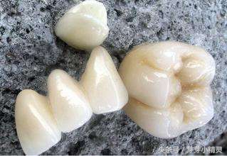 塞牙的原因和治疗方法,塞牙的罪魁祸首和危害你知道吗