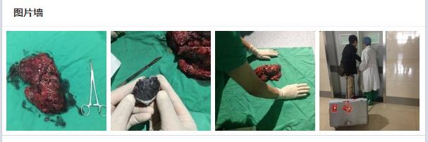 爱问医生直播尘肺移植手术阅读量达5080万互联网+