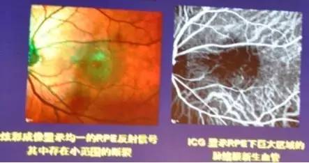 COFDS2016KarlG.Csaky：视网膜色素上皮脱离在干性AMD进展中的影响