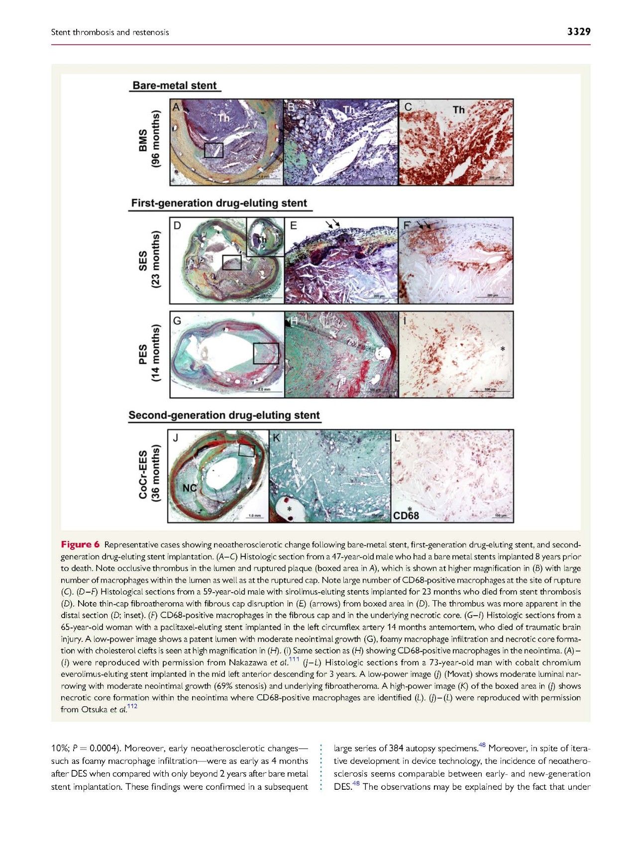 支架内血栓怎么处理,支架内血栓的原因及表现