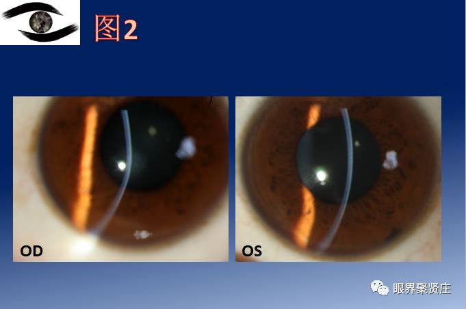 几种眼病的视野图,看图识病是什么病
