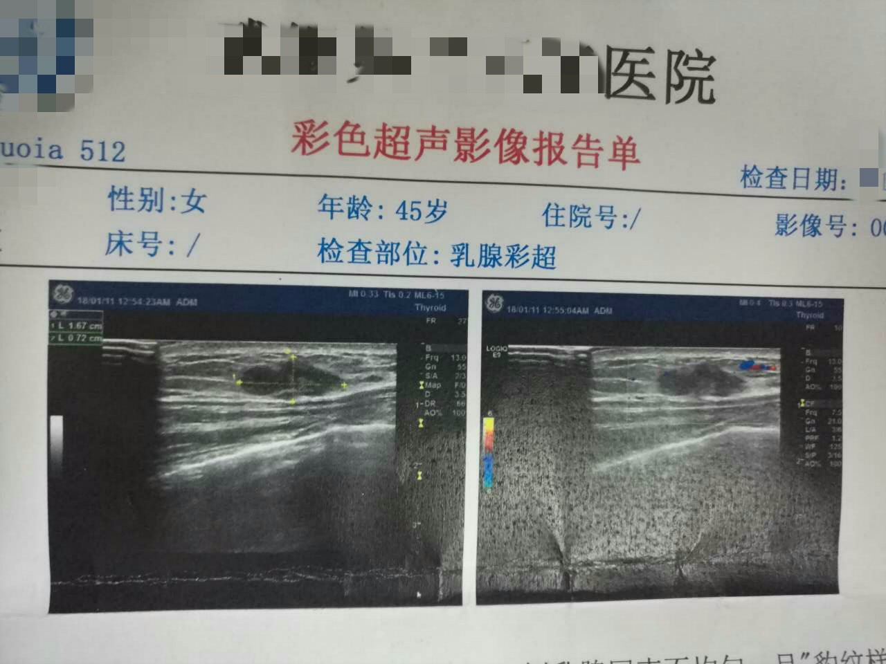 好险!谁说小乳房患癌易发现?这里有一个差点漏诊的病例