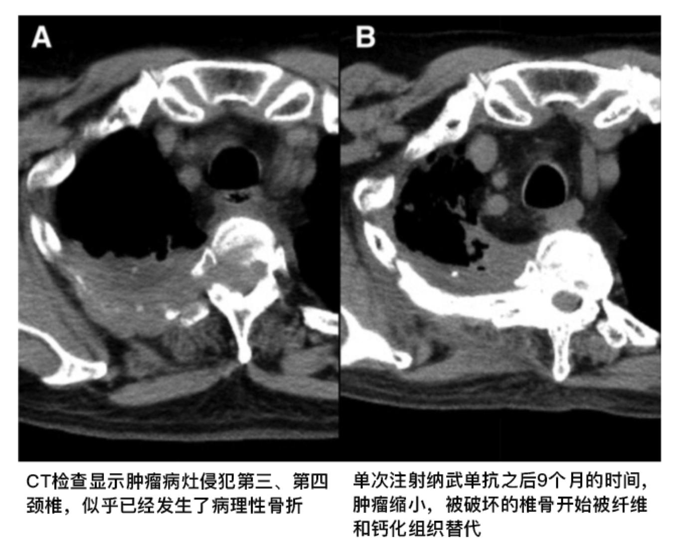 一针癌细胞清零,PD-1和PD-L1能治肺癌吗