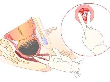 生孩子开十指痛,生孩子开十指是自己开还是医生开