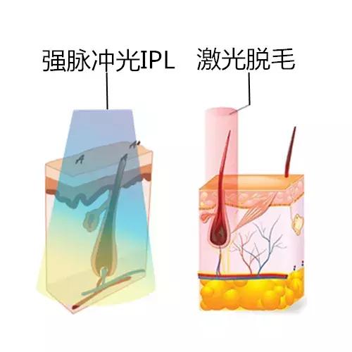 医美一键美颜的项目,比光子嫩肤更好的医美是什么