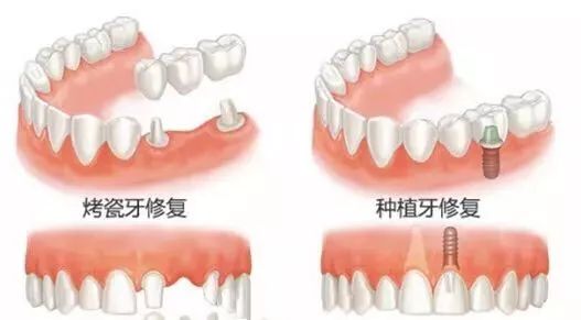多颗牙缺失做烤瓷牙还是种植牙好,牙齿缺失是种植牙好还是烤瓷牙好