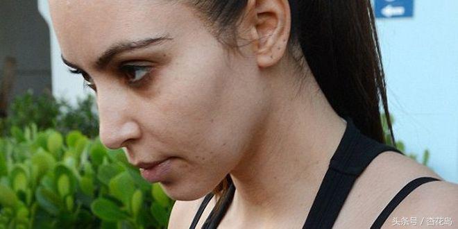 睡眠不足造成的黑眼圈怎么消除,长期睡眠不足的黑眼圈怎么消除