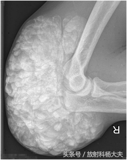 和骨肉瘤相似的病,骨肉瘤罕见病