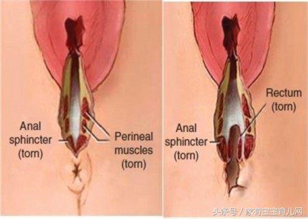 撕裂和侧切哪个好恢复,顺产侧切和撕裂哪个好恢复