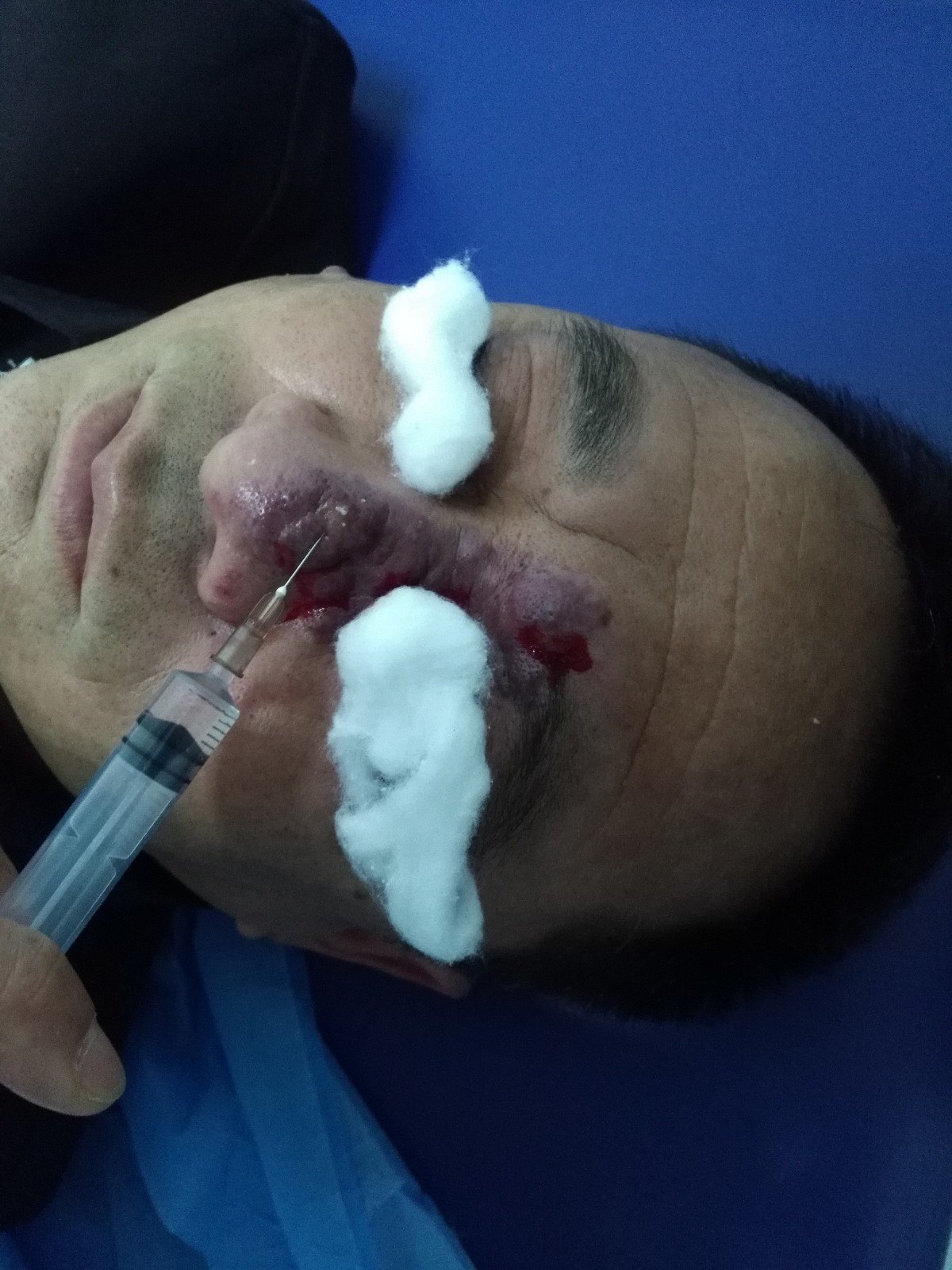 红胎记好治疗吗,红胎记好治吗