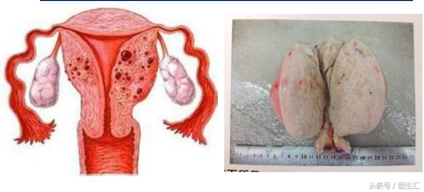 子宫腺肌症打闭经针出血还是很多,子宫腺肌症经期出血量大怎么治疗