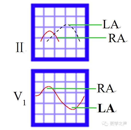 心电图课堂第22期,儿童心电图左室肥大怎么回事