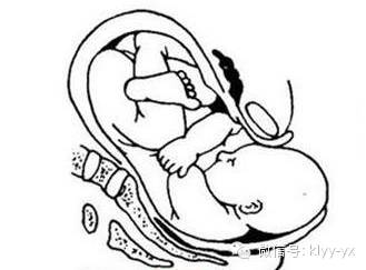 五一特辑异常妊娠：胎位不正原来是这样一回事！