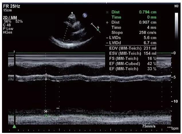 心脏扩大有什么症状和后果,心脏扩大症