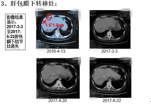 肺鳞癌能用nk细胞疗法吗,肺腺癌nkt治疗成功案例