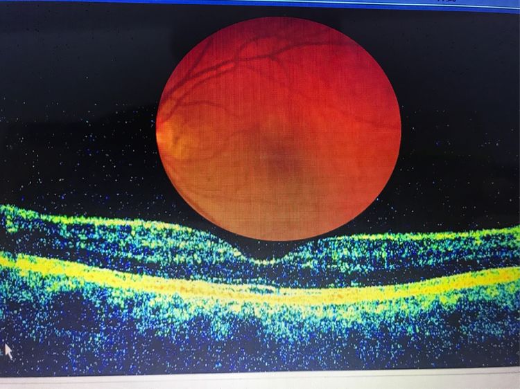 眼底黄斑凹陷怎么办,眼底黄斑怎么去除