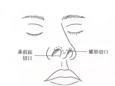 「爱美」双眼之间“一片荒芜”,鼻子一塌毁所有啊!