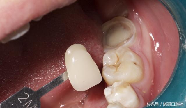 戴牙冠哪种材料便宜对人体无害,种植牙后牙冠用什么材料好